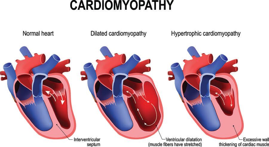 Diagram showing alcohol affect heart; includes cardiomyopathy types