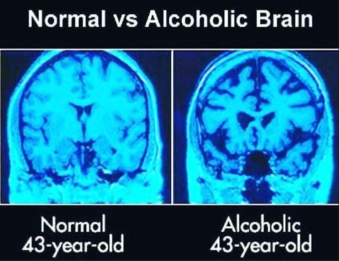 Alcohol and Depression: Brain Impact Visual Guide Brain scan comparison showing normal vs alcoholic brain - alcohol and depression