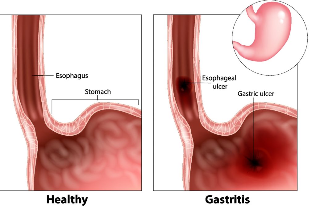 Black Vomit After Drinking: Causes and Stomach Health Image showing healthy vs. ulcerated stomach, linked to black vomit after drinking.
