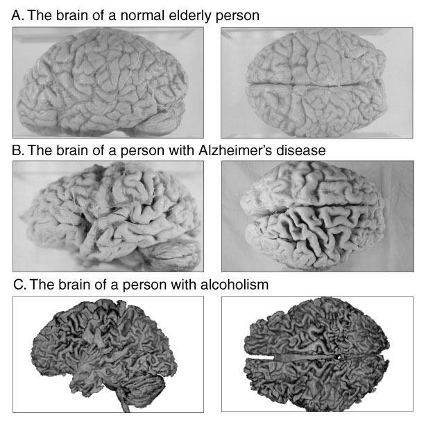 Comparing Brain Health: Effects of Alcohol and Aging Image showing effects of alcohol on brain compared to normal aging