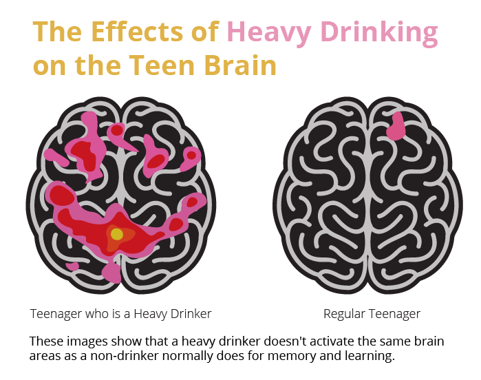 Effects of Alcohol on the Teen Brain: Visual Insights Effects of alcohol on teen brain activity comparison