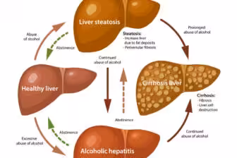 Alcoholic Fatty Liver Disease: Managing Risks from Alcohol