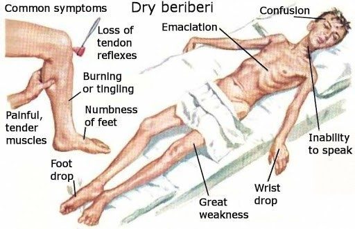 Thiamine Deficiency Symptoms in Alcohol Recovery Illustration showing thiamine deficiency signs related to alcohol abuse.